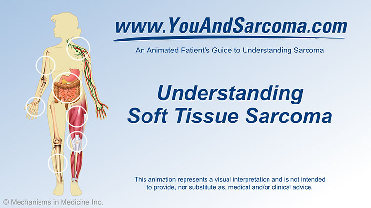 Sarcomas, Soft Tissue: Medical Illustrations