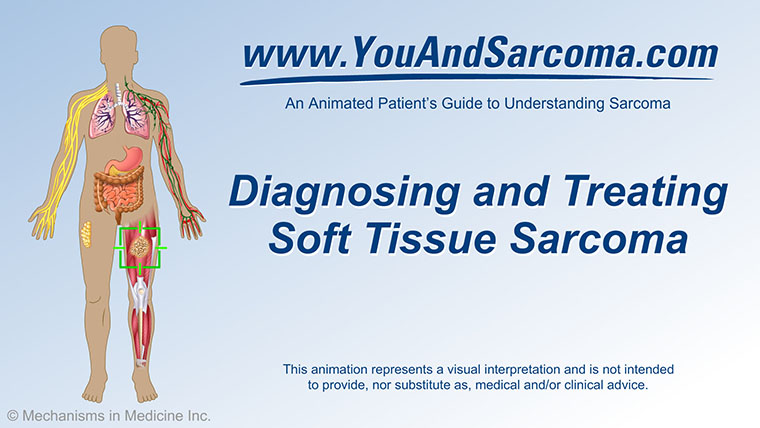 Understanding Soft Tissue Sarcoma