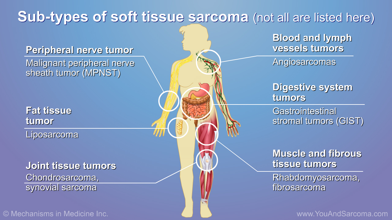 Understanding Soft Tissue Sarcoma